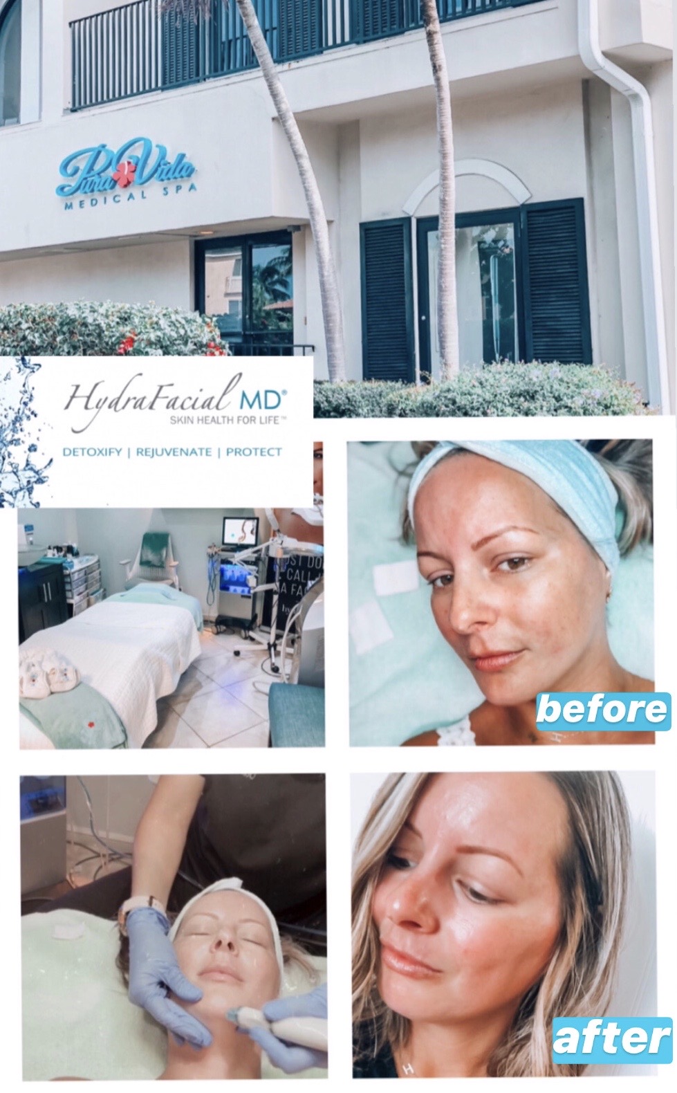 Naples, FL Medical Spa Review - Hydrafacial